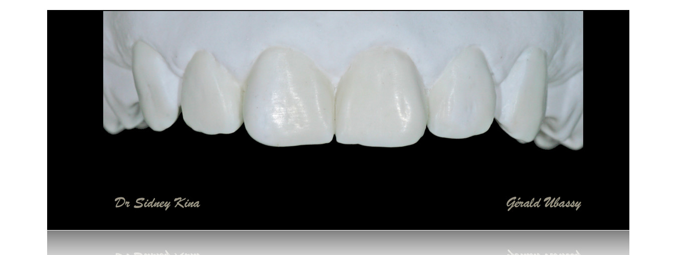 12 Veneers, Kina /Ubassy